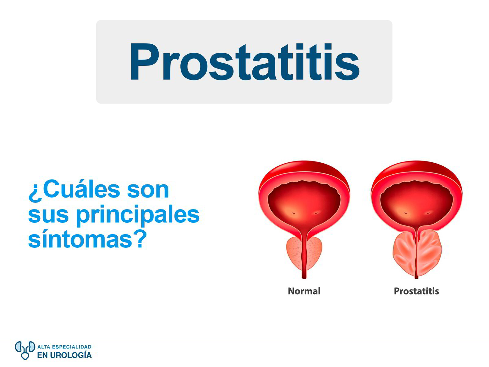 Prostatitis cuáles son sus principales síntomas