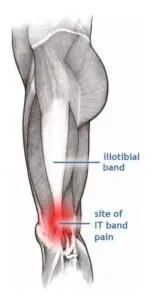 Iliotibial Band ITB Syndrome  👨‍⚕️Singapore Orthopaedic