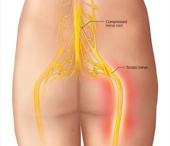 TENS Unit for Sciatica Pain - The Spine and Rehab Group