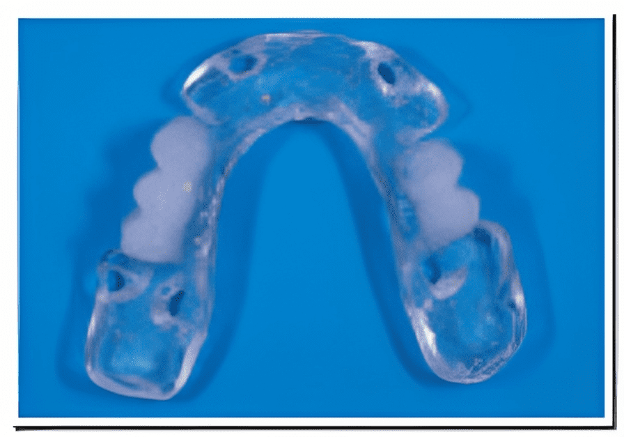 Surgical and Radiographic Guides | Hizart Dental Laboratory