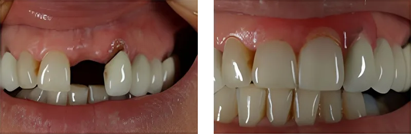 Before and after patient teeth