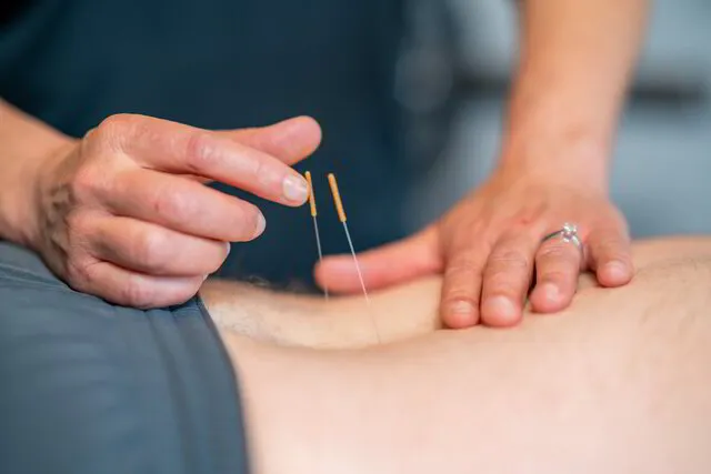 physical therapist performs dry needling
