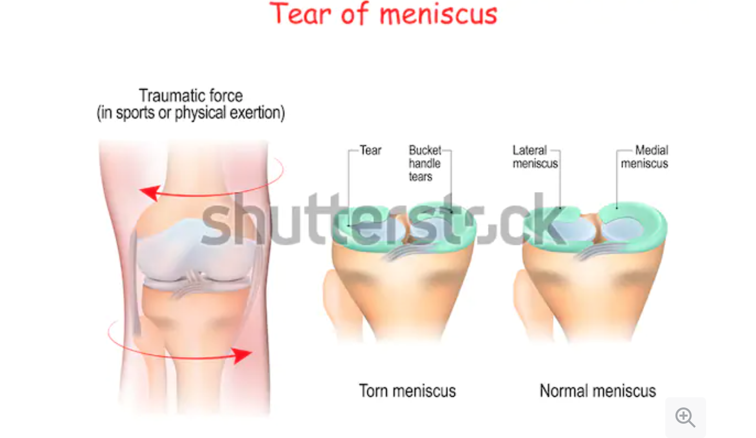 meniscus-tear