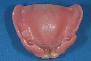 FULL DENTURE FITTING SURFACE VIEW