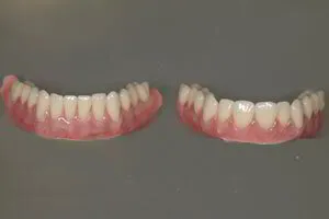 Full Upper and Lower Denture
