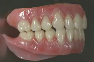 Full Upper and Lower Dentures Showing Gum Tinting