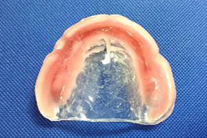 Full Upper Denture with clear palate fitting surface