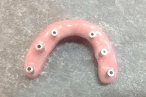  Implant-retained Full Upper Denture Surface fitting view