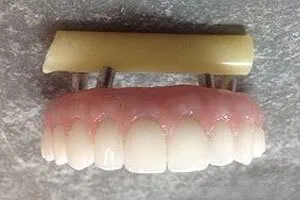 Implant-retained Full Upper Denture Front View