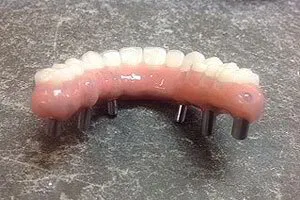 Implant-retained Full Upper Denture Side View