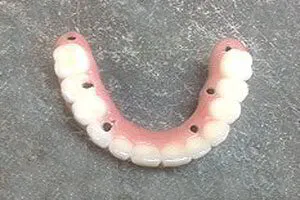 Implant-retained Full Upper Denture Top View