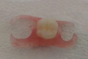 One-tooth flexible denture