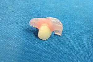 One-tooth flexible denture front view