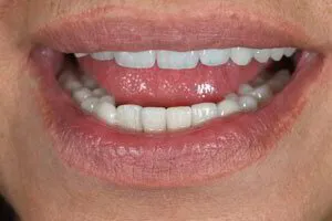 Partial Chrome Denture in the Mouth