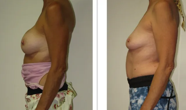 What happens after Breast Implant Removal Before and After