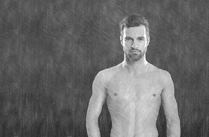 Gynecomastia and Chest correction for men with male breasts