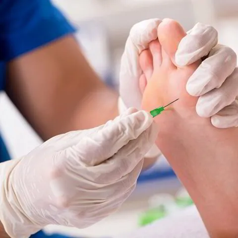 Foot Medic Verruca Needling