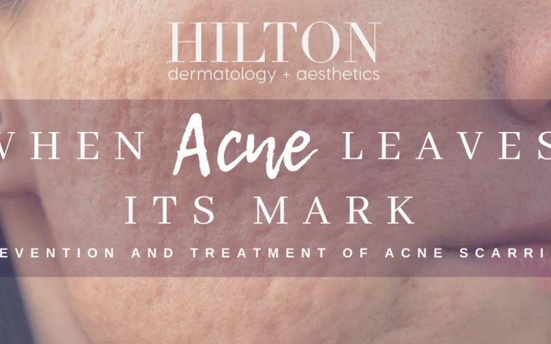WHEN ACNE LEAVES ITS MARK