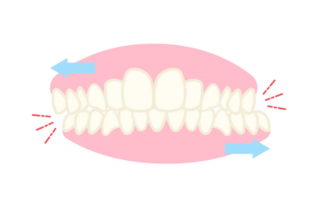 Bruxisme ou dents qui grincent : symptômes, causes et traitement ...
