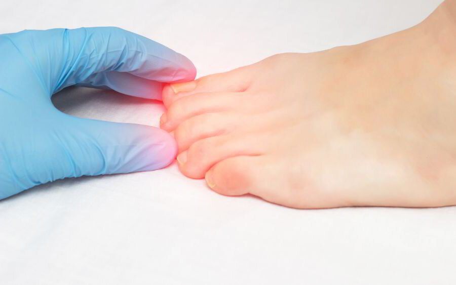 Антимикодерм при гъбички по ноктите и краката