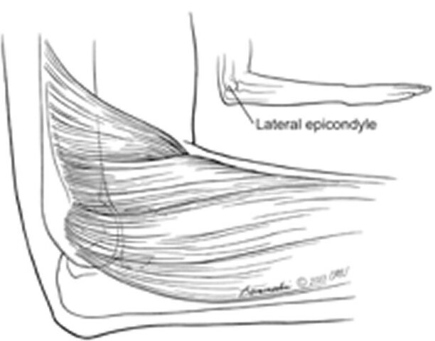 Lateral And Medial Epicondylitis