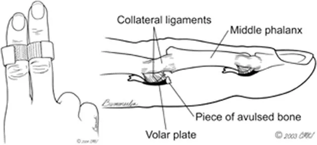 Avulsion Finger