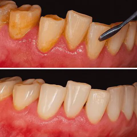 Dental Hygiene Services in Milo, ME | Mid Maine Dental Hygiene