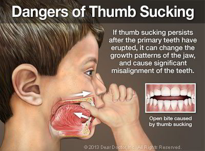 Thumb Sucking