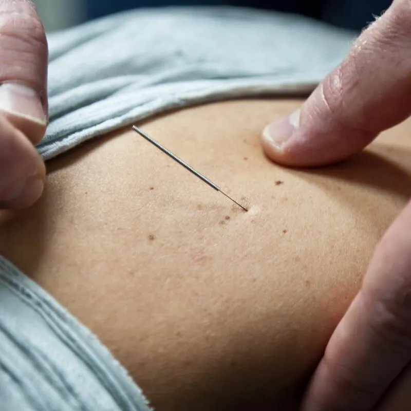 Dry Needle Therapy: How Does It Work?