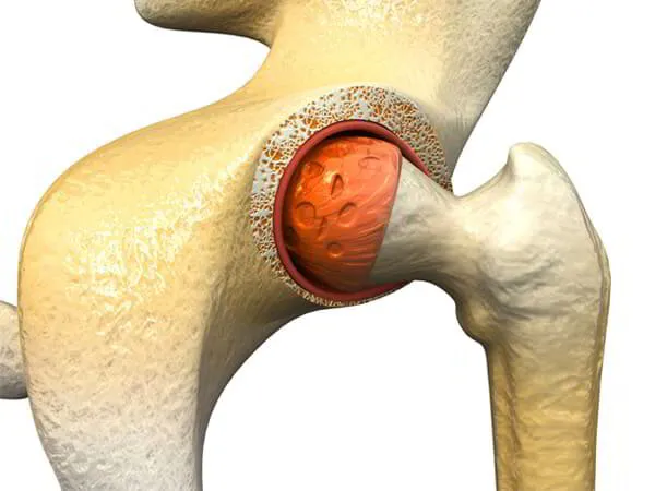 Hip Cartilage Repair Dr. Pradyumna