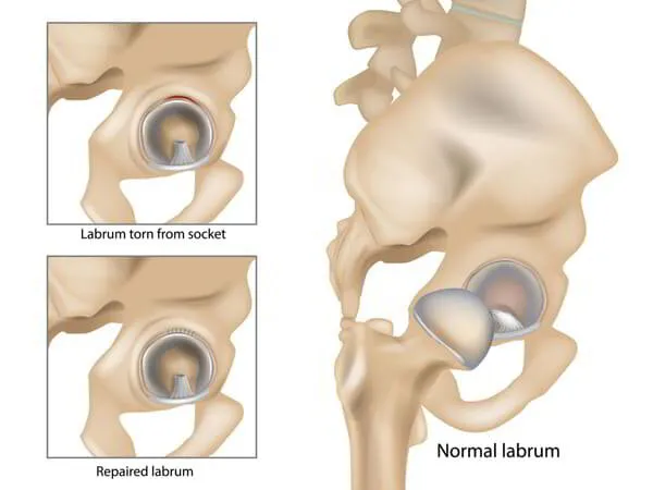 Hip Labral Repair Dr. Pradyumna