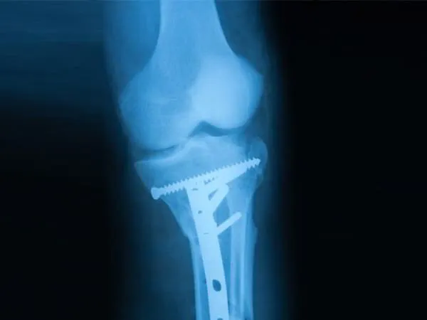 Knee Osteotomy Surgeon Dr. Pradyumna