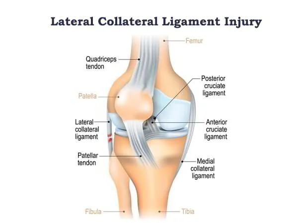 Lateral Collateral Ligament Surgery