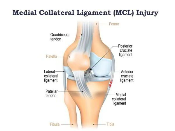 Medial Collateral Ligament (MCL) Injury Treatment Dr. Praduymna
