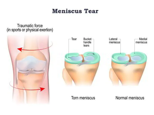 Meniscus Tear Injury Treatment Dr. Pradyumna