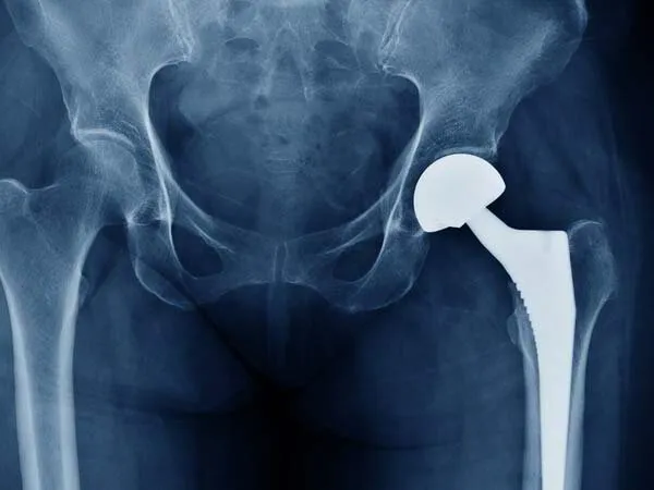 Minimally Invasive Total Hip Replacement Dr. Pradyumna