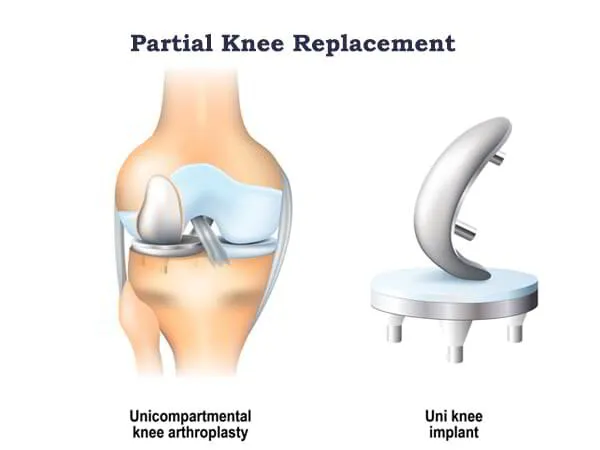 Partial Knee Replacement Dr. Pradyumna