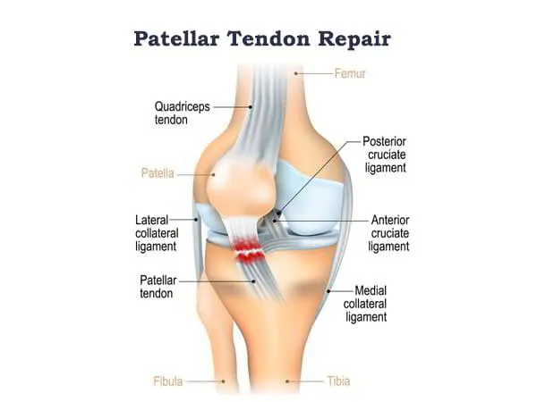 Patellar Tendon Repair Dr. Pradyumna