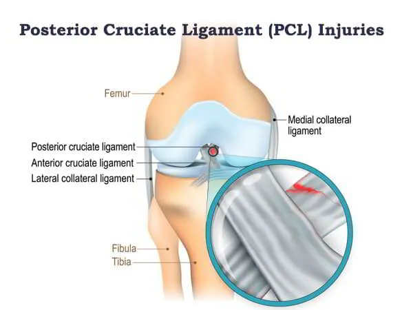 Posterior Cruciate Ligament (PCL) Injuries Treatment Dr. Pradyumna