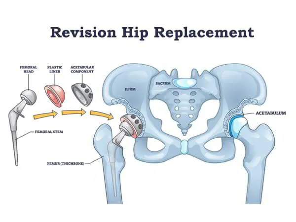 Revision Hip Replacement Dr. Pradyumna