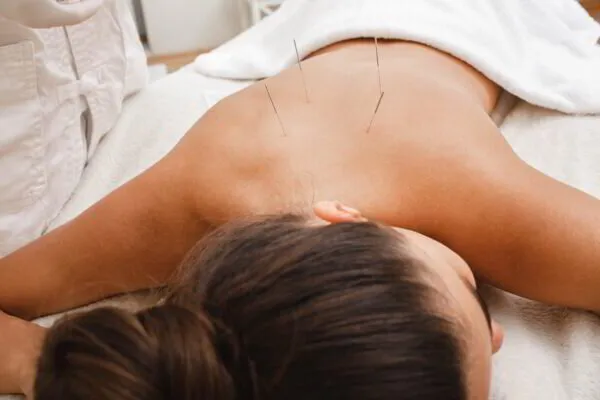 Person receiving acupuncture treatment on their back at a wellness center.