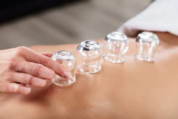 Hand performing cupping therapy on someone's back with four cups in a row.