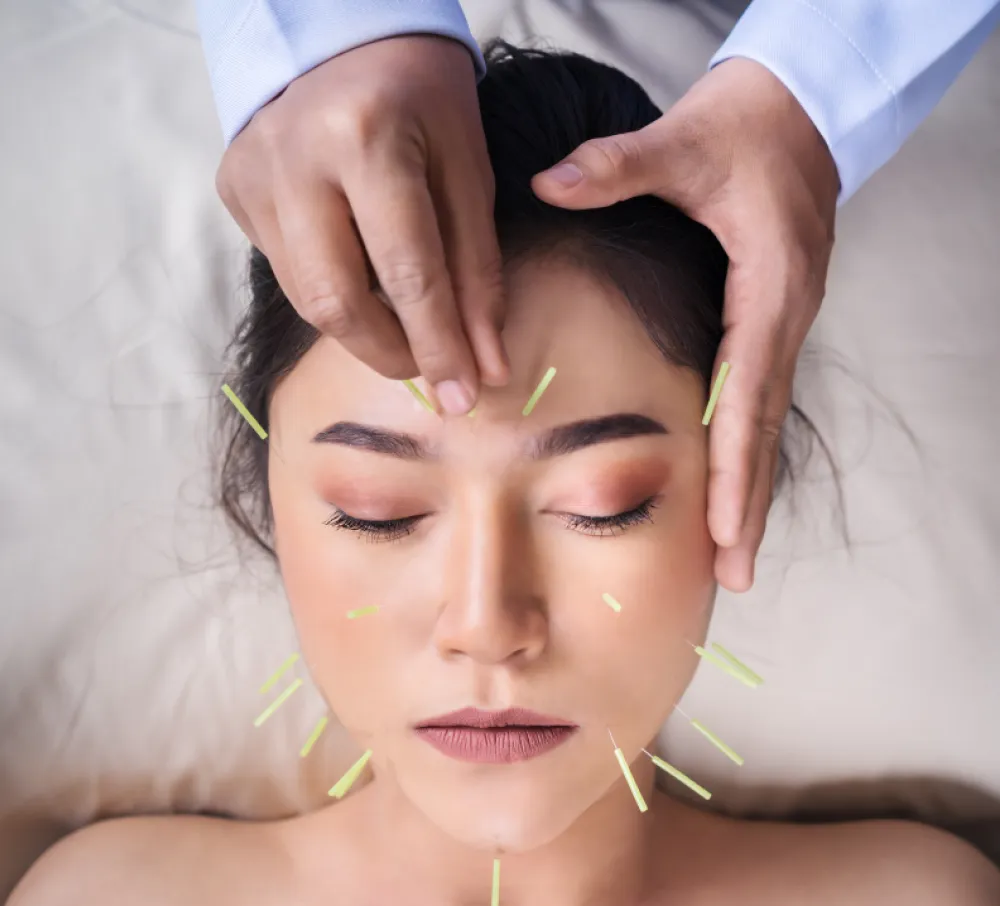 Treating Stress with Acupuncture
