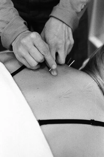 Person receiving acupuncture treatment on their back with several needles in place.
