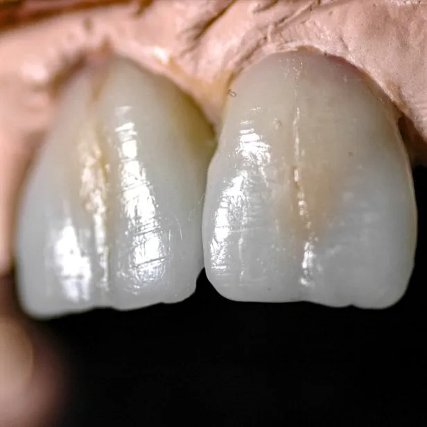 Co to jest modelowanie estetyczne zębów w wosku?