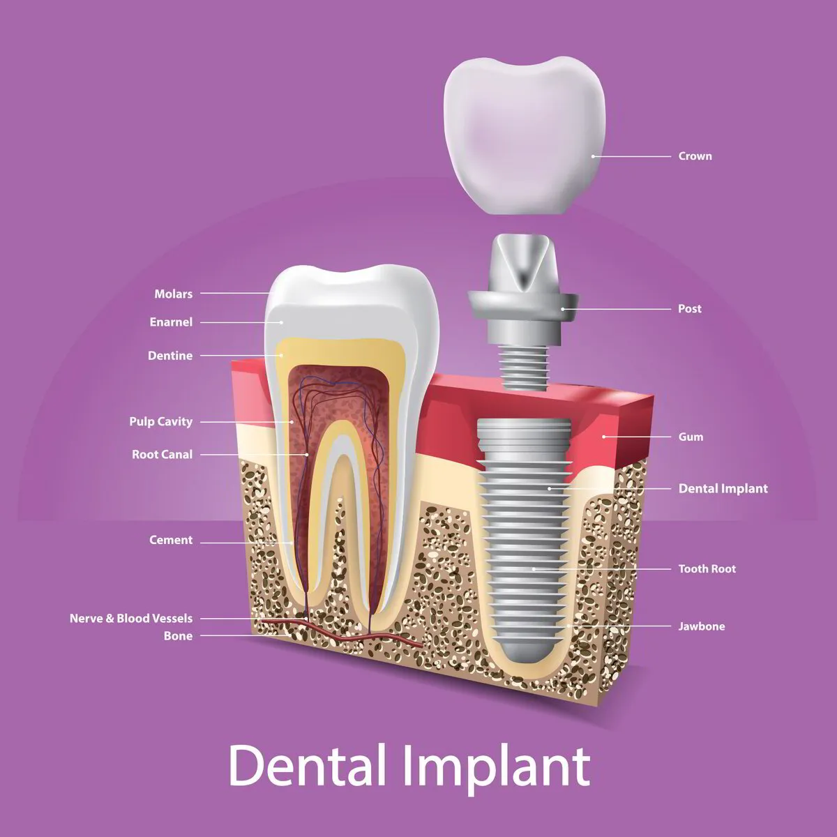 instructions Dental Implant in Lotus Dental 