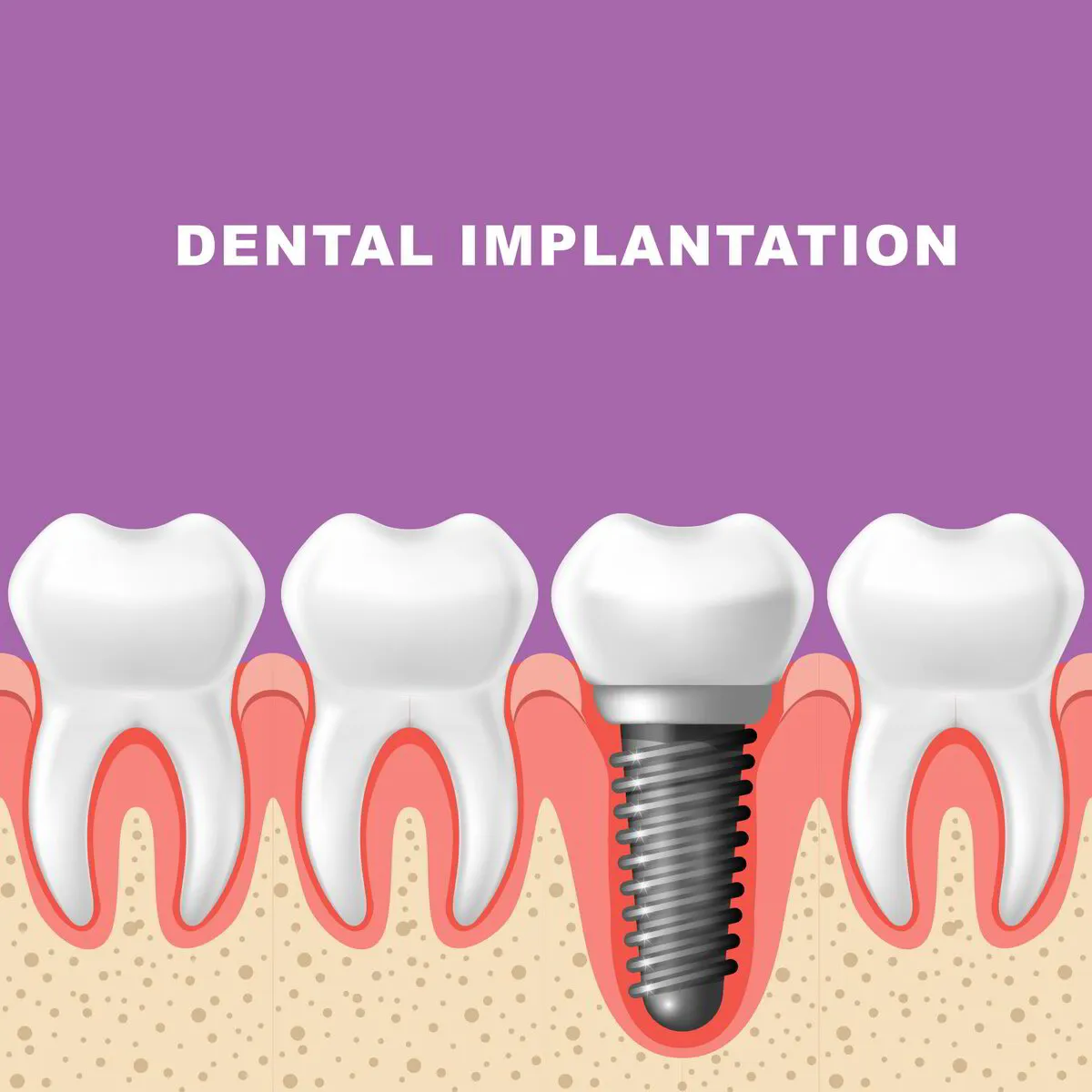 Best Dental Implantation in Lotus Dental 