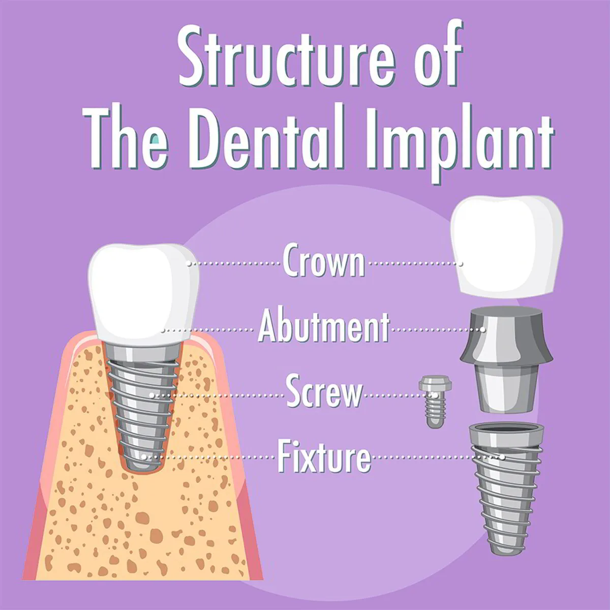 structure of tooth implant in Lotus Dental 