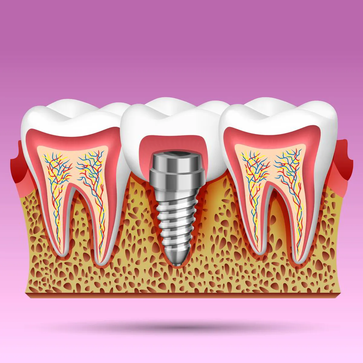 Affordable dental implant cost in Lotus Dental 