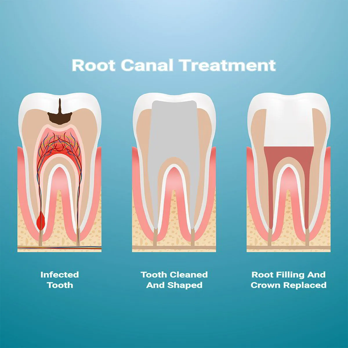 instructions of root canal treatment